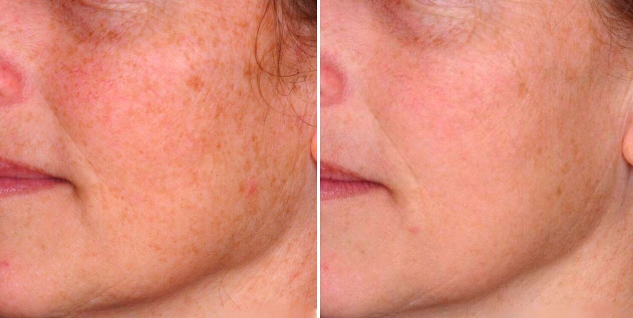 Hasil dari fototermolisis fraksional adalah pengurangan bintik-bintik penuaan pada kulit wajah. 